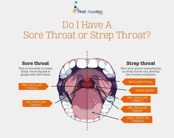 sore throat versus strep throat