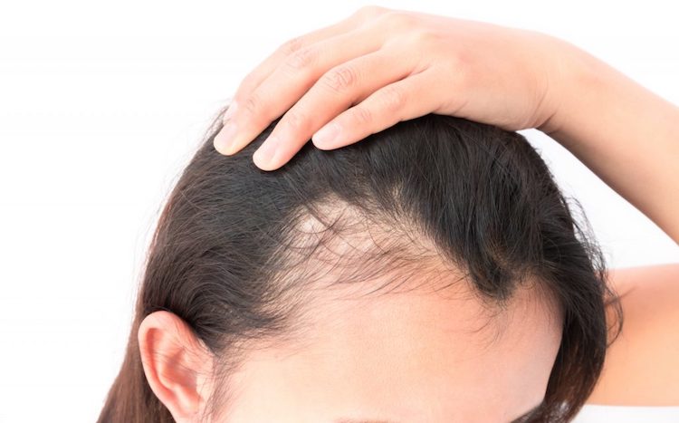 Hair-Loss-in-Women Hair Loss in Women